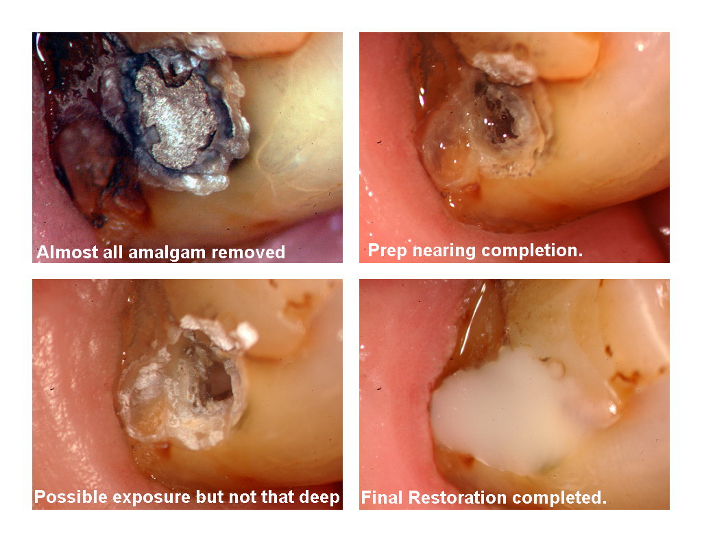 Amalgam removal pg 2.jpg